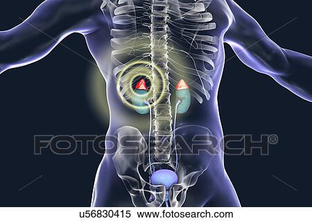 Stock Photography - Treatment of adrenal gland disease, illustration. Fotosearch