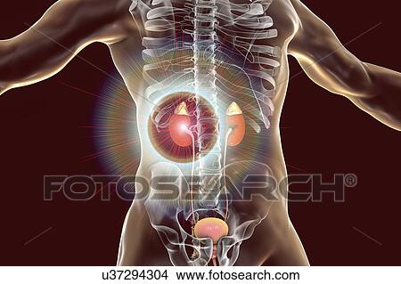 Picture - Treatment of kidney disease, illustration. Fotosearch