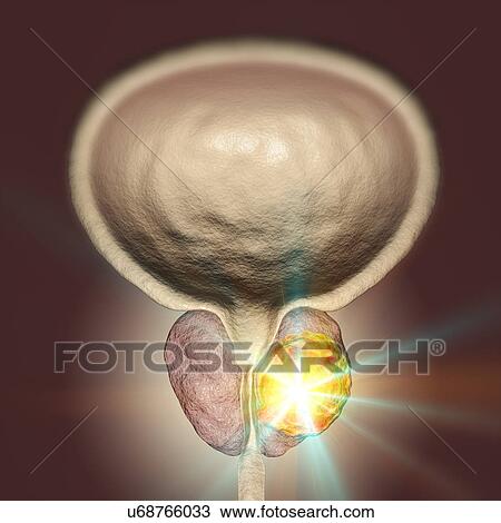 Treatment of prostate cancer, conceptual illustration. View Large Photo Image Stock Image - Treatment of prostate cancer, conceptual illustration.. Fotosearch