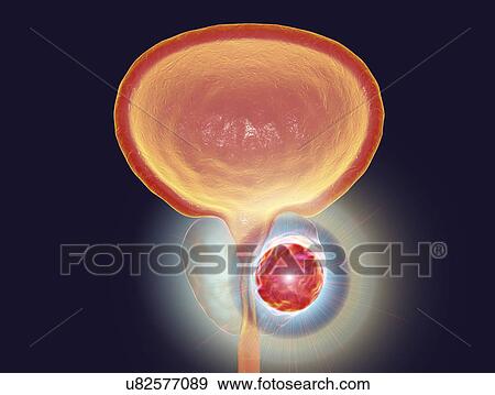 Stock Photo - Treatment of prostate cancer, conceptual illustration.. Fotosearch