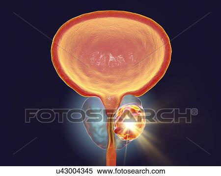 Treatment of prostate cancer, conceptual illustration. View Large Photo Image Stock Photography - Treatment of prostate cancer, conceptual illustration.. Fotosearch