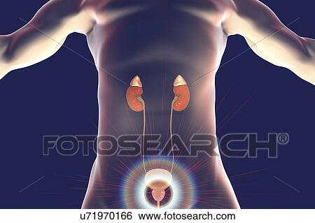 Stock Photograph - Treatment of prostate gland disease, illustration. Fotosearch