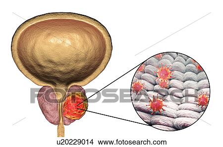 Picture - Viral etiology of prostate cancer. Conceptual illustration showing viruses infecting prostate gland and causing cancer development.. Fotosearch