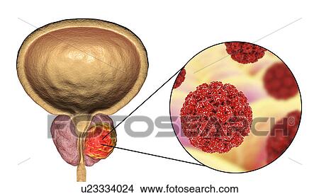 Picture - Viral etiology of prostate cancer. Conceptual illustration showing human papillomaviruses (HPV) infecting prostate gland and causing cancer development.. Fotosearch