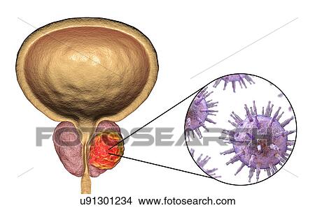 Viral etiology of prostate cancer. Conceptual illustration showing viruses infecting prostate gland and causing cancer development. View Large Photo Image Picture - Viral etiology of prostate cancer. Conceptual illustration showing viruses infecting prostate gland and causing cancer development.. Fotosearch
