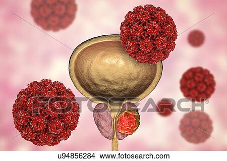 Picture - Viral etiology of prostate cancer. Conceptual illustration showing human papillomaviruses (HPV) infecting prostate gland and causing cancer development.. Fotosearch