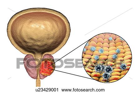 Stock Image - Viral etiology of prostate cancer. Conceptual illustration showing viruses infecting prostate gland and causing cancer development.. Fotosearch