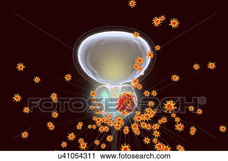 Stock Image - Viral etiology of prostate cancer. Conceptual illustration showing viruses infecting prostate gland and causing cancer development.. Fotosearch