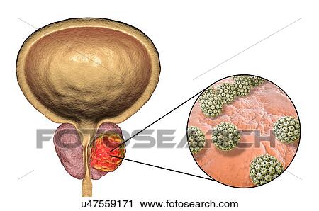 Stock Image - Viral etiology of prostate cancer. Conceptual illustration showing human papillomaviruses (HPV) infecting prostate gland and causing cancer development.. Fotosearch