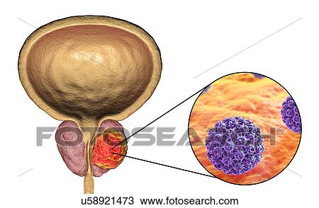 Stock Image - Viral etiology of prostate cancer. Conceptual illustration showing human papillomaviruses (HPV) infecting prostate gland and causing cancer development.. Fotosearch