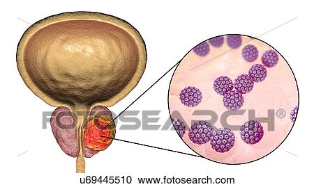 Stock Image - Viral etiology of prostate cancer. Conceptual illustration showing human papillomaviruses (HPV) infecting prostate gland and causing cancer development.. Fotosearch