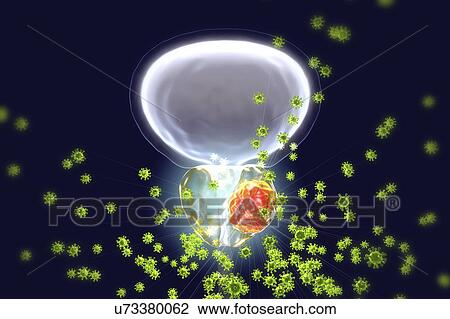 Stock Image - Viral etiology of prostate cancer. Conceptual illustration showing viruses infecting prostate gland and causing cancer development.. Fotosearch