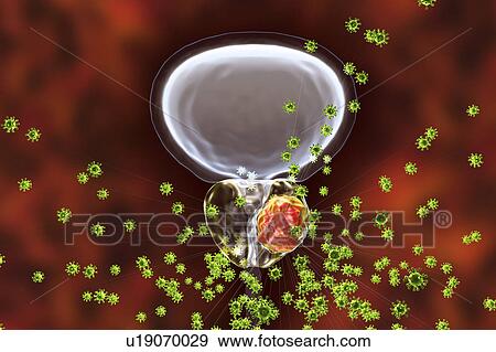 Viral etiology of prostate cancer. Conceptual illustration showing viruses infecting prostate gland and causing cancer development. View Large Photo Image Stock Photo - Viral etiology of prostate cancer. Conceptual illustration showing viruses infecting prostate gland and causing cancer development.. Fotosearch
