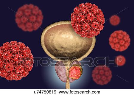Stock Photo - Viral etiology of prostate cancer. Conceptual illustration showing human papillomaviruses (HPV) infecting prostate gland and causing cancer development.. Fotosearch