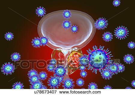 Stock Photo - Viral etiology of prostate cancer. Conceptual illustration showing viruses infecting prostate gland and causing cancer development.. Fotosearch