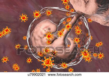 Stock Image - Viruses infecting human embryo, conceptual illustration. The embryo is 4 weeks old. Many viruses cause fetal abnormalities or stillbirth. For example, rubella, herpes and cytomegalovirus cause different fetal pathology, whilst fetal measles infection.... Fotosearch