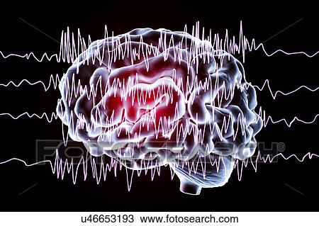 Brain and brain waves in epilepsy, computer illustration. This EEG (electroencephalogram) illustration shows generalized epilepsy, affecting the whole brain cortex: all the EEG traces show chaotic brain waves. Epilepsy can take many forms, and have... View Large Photo Image Stock Image - Brain and brain waves in epilepsy, computer illustration. This EEG (electroencephalogram) illustration shows generalized epilepsy, affecting the whole brain cortex: all the EEG traces show chaotic brain waves. Epilepsy can take many forms, and have.... Fotosearch