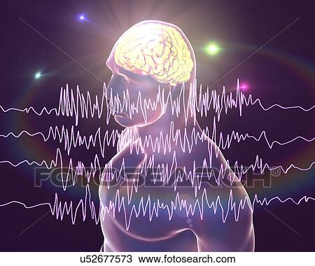 Brain and brain waves in epilepsy, computer illustration. This EEG (electroencephalogram) illustration shows generalized epilepsy, affecting the whole brain cortex: all the EEG traces show chaotic brain waves. Epilepsy can take many forms, and have... View Large Photo Image Stock Image - Brain and brain waves in epilepsy, computer illustration. This EEG (electroencephalogram) illustration shows generalized epilepsy, affecting the whole brain cortex: all the EEG traces show chaotic brain waves. Epilepsy can take many forms, and have.... Fotosearch