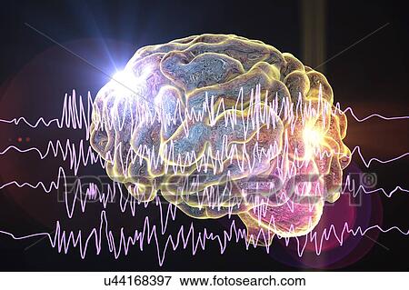 Brain and brain waves in epilepsy, computer illustration. This EEG (electroencephalogram) illustration shows generalized epilepsy, affecting the whole brain cortex: all the EEG traces show chaotic brain waves. Epilepsy can take many forms, and have... View Large Photo Image Stock Photo - Brain and brain waves in epilepsy, computer illustration. This EEG (electroencephalogram) illustration shows generalized epilepsy, affecting the whole brain cortex: all the EEG traces show chaotic brain waves. Epilepsy can take many forms, and have.... Fotosearch