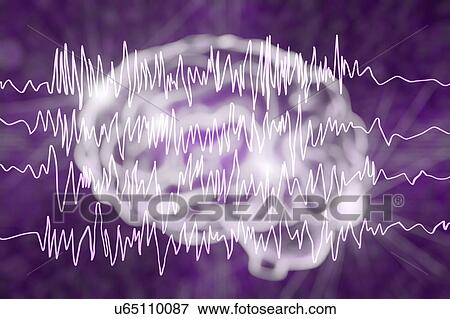Brain and brain waves in epilepsy, computer illustration. This EEG (electroencephalogram) illustration shows generalized epilepsy, affecting the whole brain cortex: all the EEG traces show chaotic brain waves. Epilepsy can take many forms, and have... View Large Photo Image Stock Photo - Brain and brain waves in epilepsy, computer illustration. This EEG (electroencephalogram) illustration shows generalized epilepsy, affecting the whole brain cortex: all the EEG traces show chaotic brain waves. Epilepsy can take many forms, and have.... Fotosearch