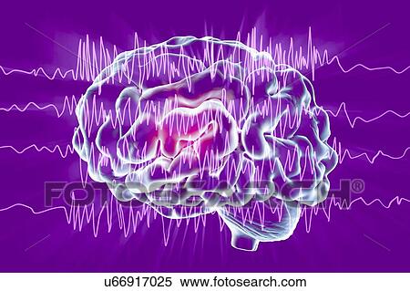 Brain and brain waves in epilepsy, computer illustration. This EEG (electroencephalogram) illustration shows generalized epilepsy, affecting the whole brain cortex: all the EEG traces show chaotic brain waves. Epilepsy can take many forms, and have... View Large Photo Image Stock Photography - Brain and brain waves in epilepsy, computer illustration. This EEG (electroencephalogram) illustration shows generalized epilepsy, affecting the whole brain cortex: all the EEG traces show chaotic brain waves. Epilepsy can take many forms, and have.... Fotosearch