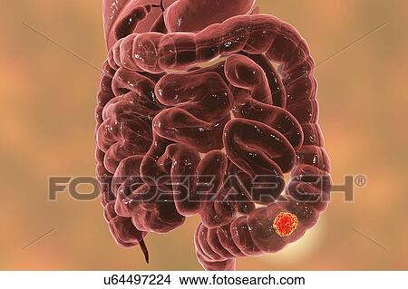 Colon cancer, computer illustration. View Large Photo Image Picture - Colon cancer, computer illustration.. Fotosearch