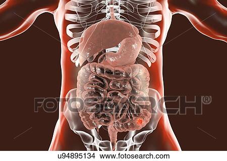 Picture - Colon cancer, computer illustration.. Fotosearch