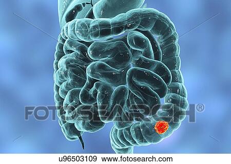 Stock Photo - Colon cancer, computer illustration.. Fotosearch