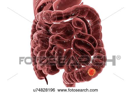 Stock Photograph - Colon cancer, computer illustration.. Fotosearch