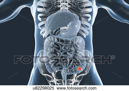 Colon cancer, computer illustration. View Large Photo Image Stock Photography - Colon cancer, computer illustration.. Fotosearch