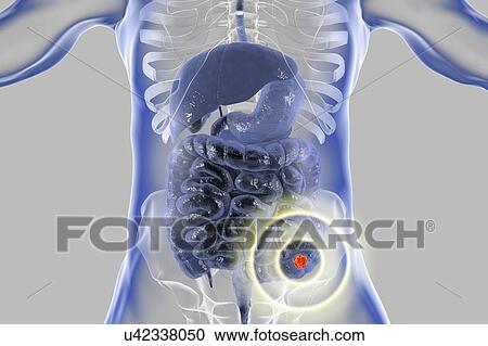 Stock Image - Colon cancer treatment, conceptual computer illustration.. Fotosearch