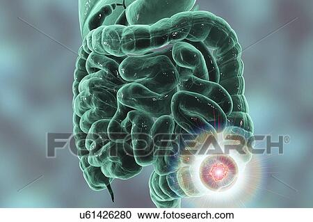 Stock Image - Colon cancer treatment, conceptual computer illustration.. Fotosearch