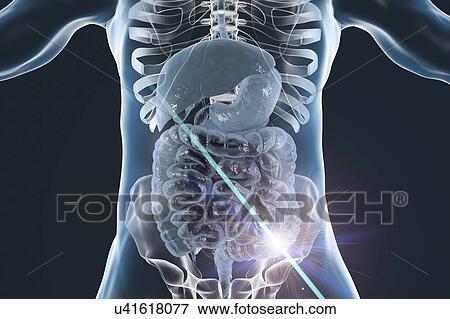 Colon cancer treatment, conceptual computer illustration. View Large Photo Image Stock Photo - Colon cancer treatment, conceptual computer illustration.. Fotosearch