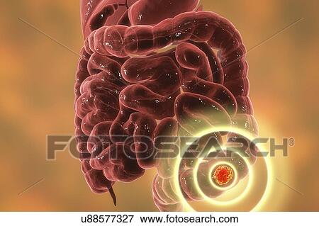 Colon cancer treatment, conceptual computer illustration. View Large Photo Image Stock Photo - Colon cancer treatment, conceptual computer illustration.. Fotosearch