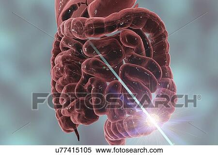 Stock Photography - Colon cancer treatment, conceptual computer illustration.. Fotosearch
