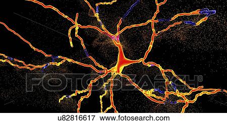 Stock Photo - Conceptual illustration of the degeneration of a dopaminergic neuron, the key step in development of Parkinson's disease.. Fotosearch