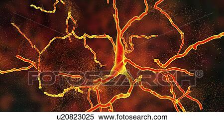 Stock Photography - Conceptual illustration of the degeneration of a dopaminergic neuron, the key step in development of Parkinson's disease.. Fotosearch