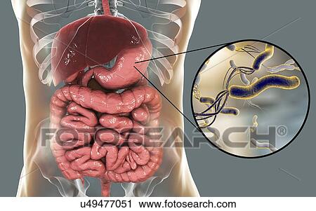 Stock Image - Helicobacter pylori bacteria. Computer illustration of Helicobacter pylori bacteria in a human stomach. Formerly known as Campylobacter pyloridis, these are spiral-shaped Gram-negative bacteria. The terminal flagella (hair-like structures) are used.... Fotosearch