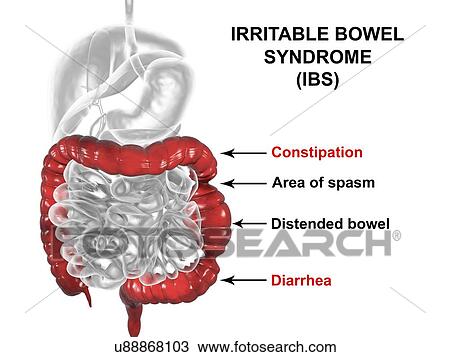 Stock Image - Irritable bowel syndrome. Illustration of a digestive system suffering from irritable bowel syndrome (IBS). IBS is also known as spastic colon or irritable colon syndrome. It causes abdominal pain and cramps, and irregular bowel habits such as.... Fotosearch