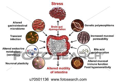 Stock Photograph - Irritable bowel syndrome, pathophysiology. Illustration of a digestive system suffering from irritable bowel syndrome (IBS). IBS is also known as spastic colon or irritable colon syndrome. It causes abdominal pain and cramps, and irregular bowel.... Fotosearch