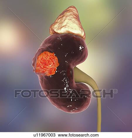 Stock Image - Kidney cancer, computer illustration.. Fotosearch
