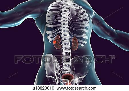 Stock Image - Kidney cancer, computer illustration.. Fotosearch