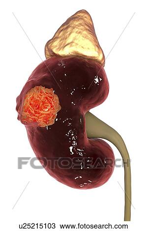 Kidney cancer, computer illustration. View Large Photo Image Stock Image - Kidney cancer, computer illustration.. Fotosearch