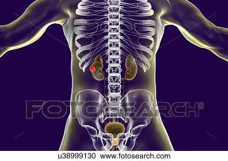 Kidney cancer, computer illustration. View Large Photo Image Stock Image - Kidney cancer, computer illustration.. Fotosearch