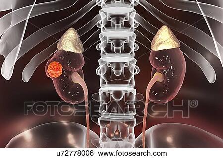 Kidney cancer, computer illustration. View Large Photo Image Stock Photograph - Kidney cancer, computer illustration.. Fotosearch