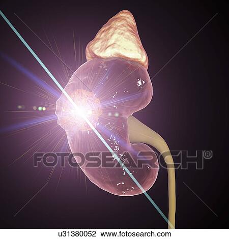 Kidney cancer laser photoablation treatment, conceptual computer illustration. View Large Photo Image Stock Image - Kidney cancer laser photoablation treatment, conceptual computer illustration.. Fotosearch