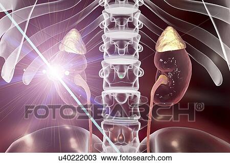 Kidney cancer laser photoablation treatment, conceptual computer illustration. View Large Photo Image Stock Image - Kidney cancer laser photoablation treatment, conceptual computer illustration.. Fotosearch