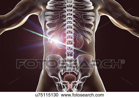 Stock Image - Kidney cancer laser photoablation treatment, conceptual computer illustration.. Fotosearch