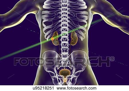 Kidney cancer laser photoablation treatment, conceptual computer illustration. View Large Photo Image Stock Image - Kidney cancer laser photoablation treatment, conceptual computer illustration.. Fotosearch