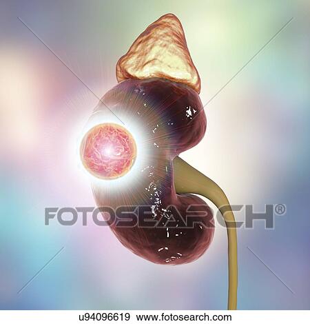 Kidney cancer treatment concept, computer illustration. View Large Photo Image Stock Photo - Kidney cancer treatment concept, computer illustration.. Fotosearch